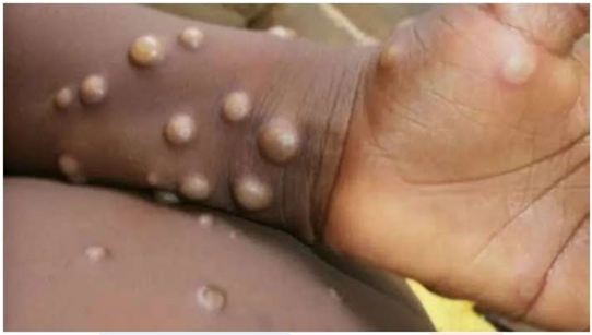 Monkeypox scare in India: 