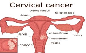 India’s first HPV Vaccine for Cervical Cancer
